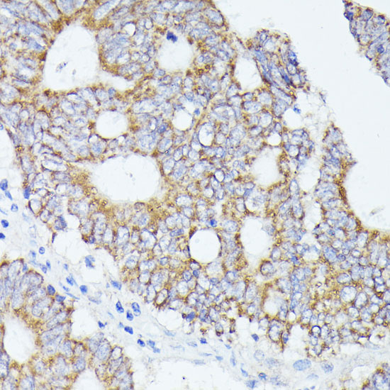 Immunohistochemistry of paraffin-embedded human colon carcinoma using ACAT2 antibody  at dilution of 1:100 