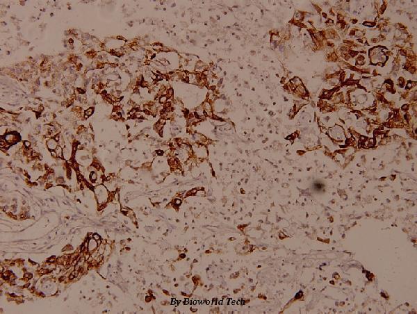 Immunohistochemistry (IHC) analyzes of LEKTI (H525) pAb in paraffin-embedded human breast carcinoma tissue at 1:100