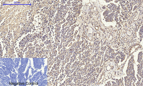 Immunohistochemical analysis of paraffin-embedded Human-lung-cancer tissue