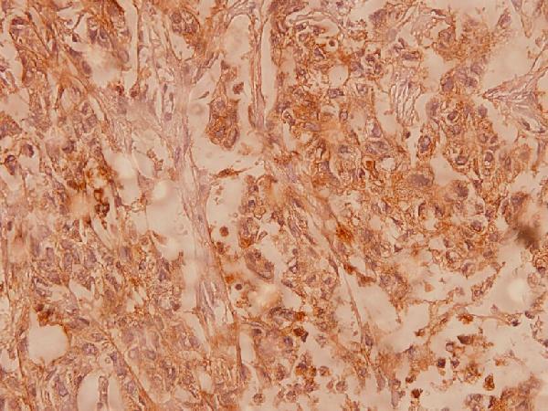 Immunohistochemistry (IHC) analyzes of Claudin-5 (S201) pAb in paraffin-embedded human breast carcinoma tissue at 1:100