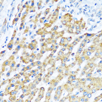 Immunohistochemistry of paraffin-embedded human breast cancer using LRPPRC Rabbit pAb  at dilution of 1:250 