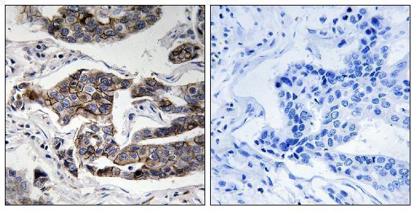 Immunohistochemistry analysis of paraffin-embedded human breast carcinoma, using Girdin (Phospho-Ser1417) Antibody