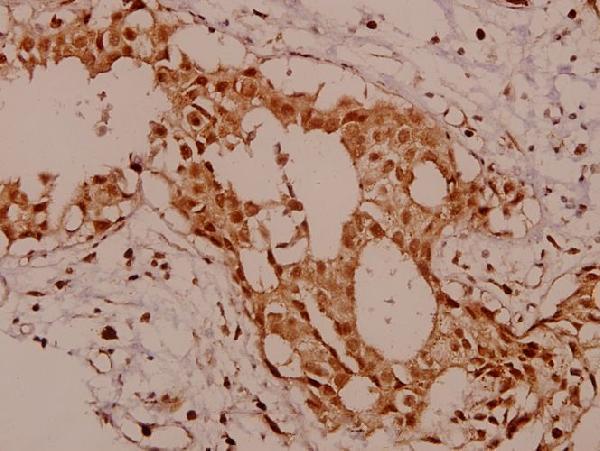 Immunohistochemistry (IHC) analyzes of KSR (R386) pAb in paraffin-embedded human breast carcinoma tissue at 1:50