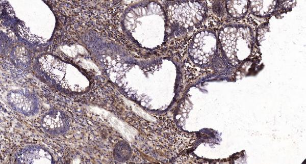 Immunohistochemical analysis of paraffin-embedded human colon cancer