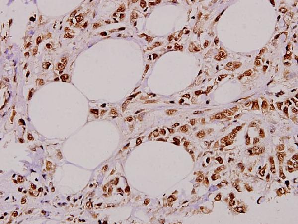 Immunohistochemistry (IHC) analyzes of ZIP-kinase (K261) pAb in paraffin-embedded human breast carcinoma tissue at 1:100