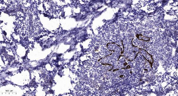 Immunohistochemical analysis of paraffin-embedded human Breast cancer