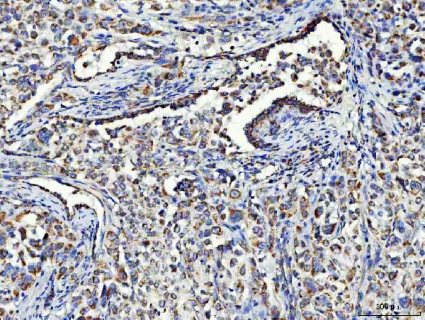  IHC analysis of Asparagine synthetase/ASNS using anti-Asparagine synthetase/ASNS antibody (A03302-2)