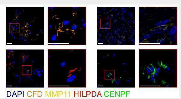 Immunohistochemical analysis of paraffin-embedded human liver cancer