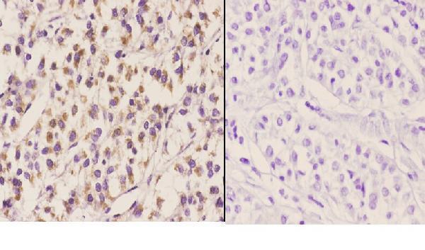 Immunohistochemistry (IHC) analyzes of ELL (D125) pAb in paraffin-embedded human liver carcinoma tissue at 1:50