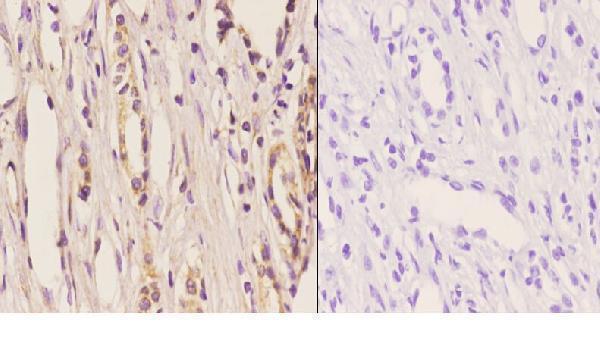 Immunohistochemistry (IHC) analyzes of ELL (D125) pAb in paraffin-embedded human kidney carcinoma tissue at 1:50