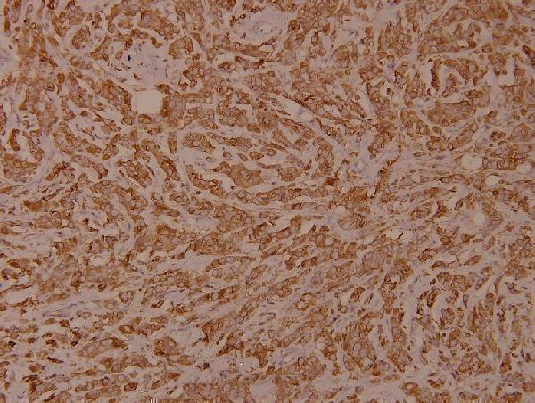 Immunohistochemistry (IHC) analyzes of p-Calnexin (S583) pAb in paraffin-embedded human breast carcinoma tissue at 1:100