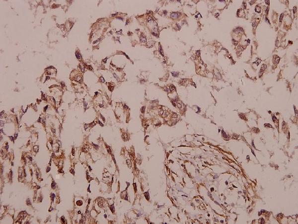 Immunohistochemistry (IHC) analyzes of Siah-2 (E266) pAb in paraffin-embedded human colorectal carcinoma tissue at 1:50