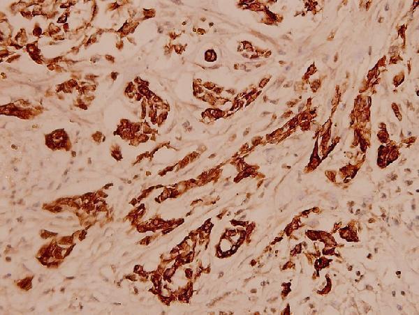 Immunohistochemistry (IHC) analyzes of Cytokeratin 16 (S451) pAb in paraffin-embedded human breast carcinoma tissue at 1:100
