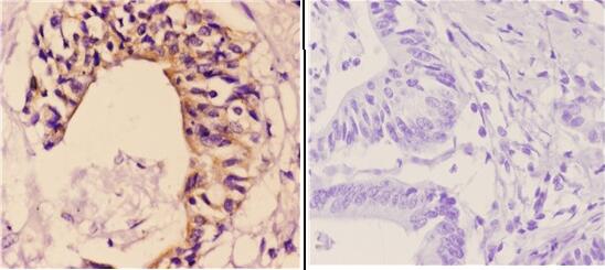 Immunohistochemistry (IHC) analyzes of Maspin (T118) pAb in paraffin-embedded colon carcinoma tissue at 1:50 showing Secreted and Extracellular space staining