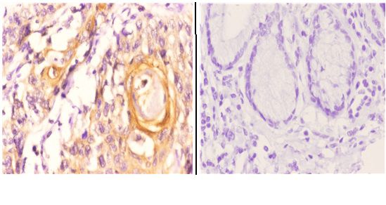 Immunohistochemistry (IHC) analyzes of Maspin (T118) pAb in paraffin-embedded esophageal carcinoma tissue at 1:50 showing Secreted and Extracellular space staining
