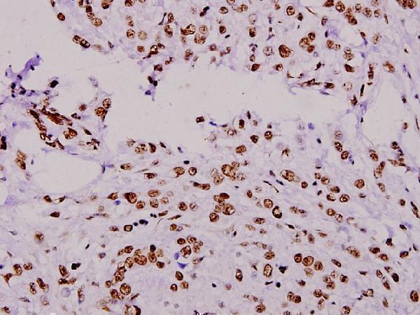 Immunohistochemistry (IHC) analyzes of ERF (E520) pAb in paraffin-embedded human breast carcinoma tissue at 1:100