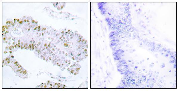 Immunohistochemistry analysis of paraffin-embedded human colon carcinoma tissue, using ERF Antibody
