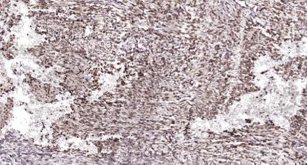 Immunohistochemical analysis of paraffin-embedded human Colon cancer