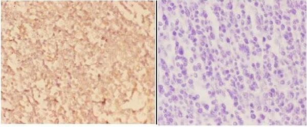 Immunohistochemistry (IHC) analyzes of ACTR3 pAb in paraffin-embedded human tonsil carcinoma tissue at 1:50,showing cytoplasmic and perinuclear staining