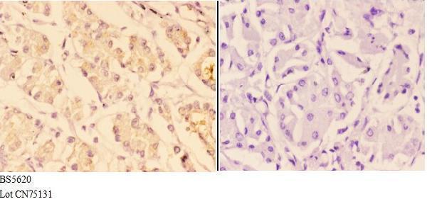 Immunohistochemistry (IHC) analyzes of ACTR3 pAb in paraffin-embedded human stomach carcinoma tissue at 1:50,showing cytoplasmic and perinuclear staining