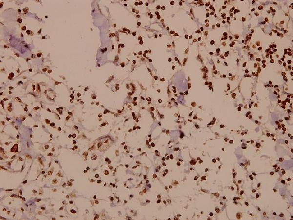 Immunohistochemistry (IHC) analyzes of DARPP-32 (P69) pAb in paraffin-embedded human breast carcinoma tissue at 1:50