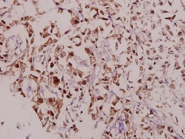 Immunohistochemistry (IHC) analyzes of p-DARPP-32 (T75) pAb in paraffin-embedded human colorectal carcinoma tissue at 1:50