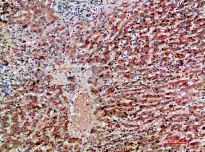 Immunohistochemical analysis of paraffin-embedded human-liver-cancer, antibody was diluted at 1:200