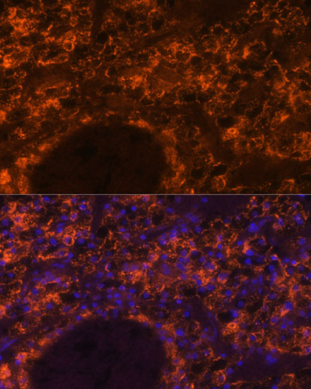 Immunofluorescence analysis of human kidney cancer using SLC7A9 antibody  at dilution of 1:100
