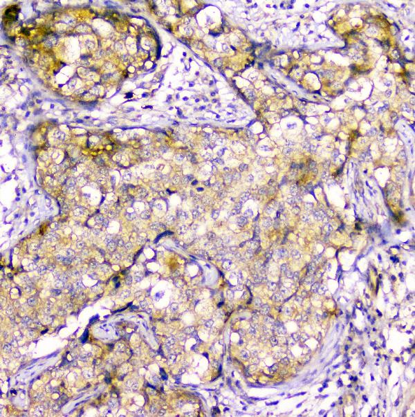 IHC analysis of Creatine Kinase MM using anti-Creatine Kinase MM antibody (A03452-1). Creatine Kinase MM was detected in paraffin-embedded section of human mammary cancer tissues. Heat mediated antigen retrieval was performed in citrate buffer (pH6, epitope retrieval solution) for 20 mins. The tissue section was blocked with 10% goat serum. The tissue section was then incubated with 1μg/ml rabbit anti-Creatine Kinase MM Antibody (A03452-1) overnight at 4°C. Biotinylated goat anti-rabbit IgG was used as secondary antibody and incubated for 30 minutes at 37°C. The tissue section was developed using Strepavidin-Biotin-Complex (SABC)(Catalog # SA1022) with DAB as the chromogen.