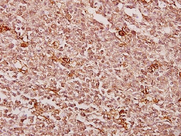 Immunohistochemistry (IHC) analyzes of Creatine Kinase M (Y14) pAb in paraffin-embedded human tonsil carcinoma tissue at 1:50