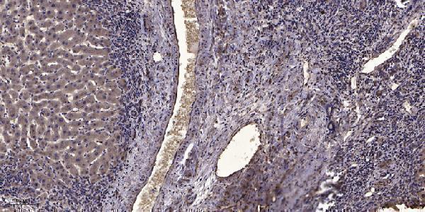 Immunohistochemical analysis of paraffin-embedded human liver cancer