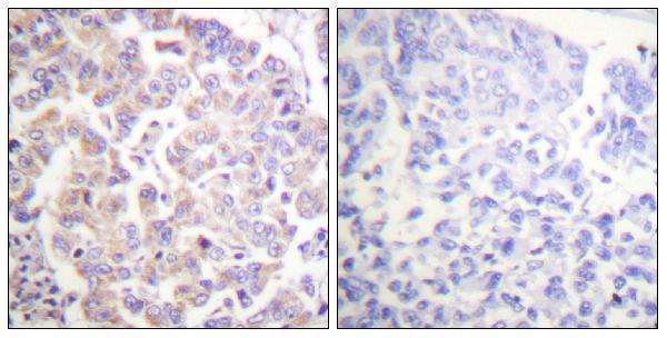 Immunohistochemistry analysis of paraffin-embedded human breast carcinoma, using APC1 (Phospho-Ser688) Antibody