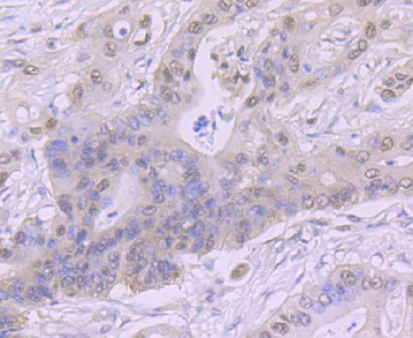 Immunohistochemical analysis of paraffin-embedded human colon cancer tissue using anti-CSNK2B antibody