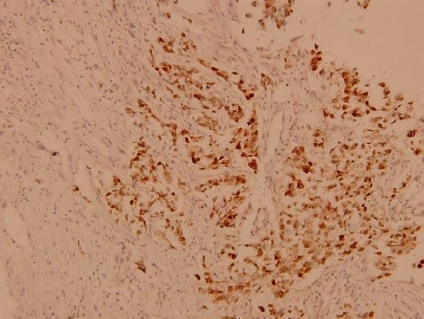 Immunohistochemistry (IHC) analyzes of Casein Kinase IIβ (S205) pAb in paraffin-embedded human breast carcinoma tissue at 1:100