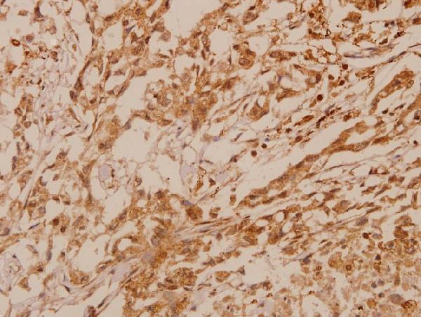 Immunohistochemistry (IHC) analyzes of MKP-2 (Y108) pAb in paraffin-embedded human breast carcinoma tissue at 1:50
