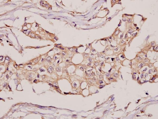 Immunohistochemistry (IHC) analyzes of CYB5R3 (I169) pAb in paraffin-embedded human breast carcinoma tissue at 1:50