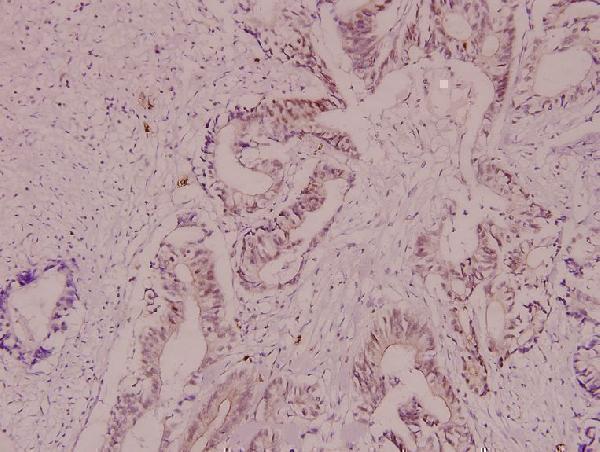 Immunohistochemistry (IHC) analyzes of Crystallin-αB (S41) pAb in paraffin-embedded human colorectal cancer carcinoma tissue at 1:100