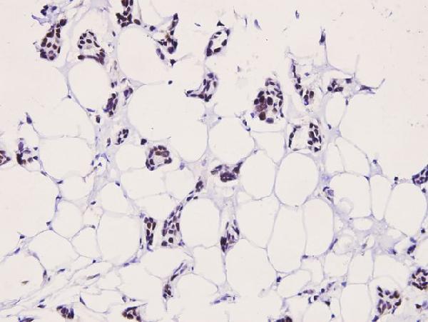 Immunohistochemistry (IHC) analyzes of p-LIMK2 (T505) pAb in paraffin-embedded human breast carcinoma tissue at 1:100