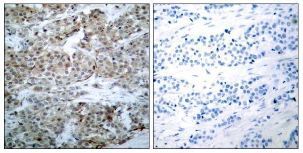 Immunohistochemistry analysis of paraffin-embedded human breast carcinoma, using BAD (Phospho-Ser112) Antibody