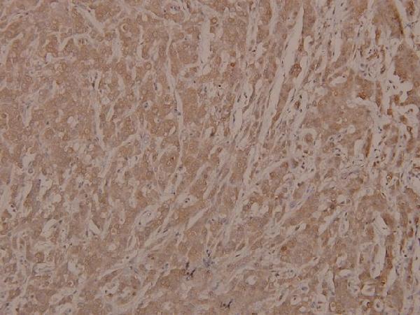 Immunohistochemistry (IHC) analyzes of p-Bad (S112) pAb in paraffin-embedded human breast carcinoma tissue at 1:100