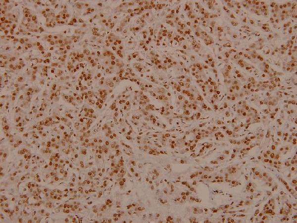 Immunohistochemistry (IHC) analyzes of p-Bad (S136) pAb in paraffin-embedded human breast carcinoma tissue at 1:100