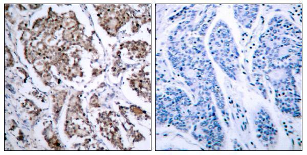 Immunohistochemistry analysis of paraffin-embedded human breast carcinoma, using BAD (Phospho-Ser155) Antibody