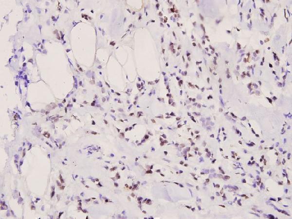 Immunohistochemistry (IHC) analyzes of p-Bad (S155) pAb in paraffin-embedded human breast carcinoma tissue at 1:100