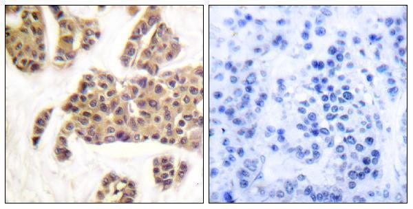 Immunohistochemistry analysis of paraffin-embedded human breast carcinoma, using BAD (Phospho-Ser91/128) Antibody