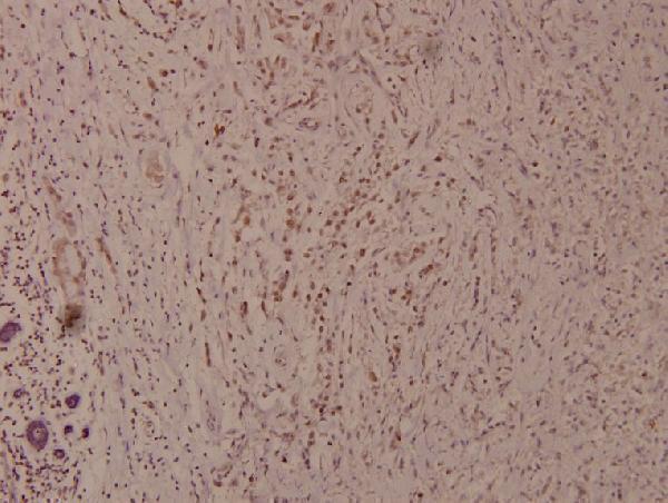 Immunohistochemistry (IHC) analyzes of p-Bad (S91) pAb in paraffin-embedded human breast carcinoma tissue at 1:100