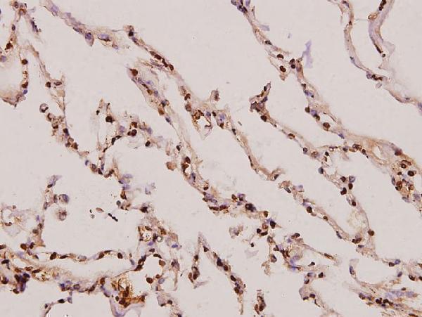 Immunohistochemistry (IHC) analyzes of Synoretin (A111) pAb in paraffin-embedded human lung carcinoma tissue at 1:100