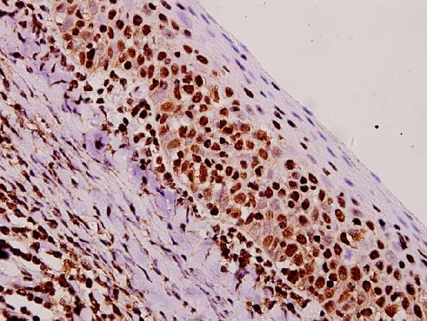 Immunohistochemistry (IHC) analyzes of NF-YA (K290) pAb in paraffin-embedded human tonsil carcinoma tissue at 1:50