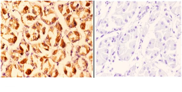 Immunohistochemistry (IHC) analyzes of CLN6 (N258) pAb in paraffin-embedded human stomach carcinoma tissue at 1:50
