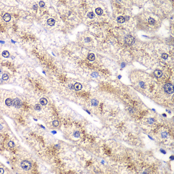 Immunohistochemistry of paraffin-embedded human liver damage using RALB antibody at dilution of 1:100 (40x lens)