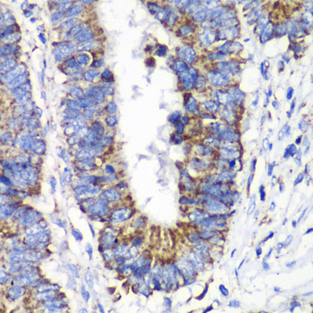 Immunohistochemistry of paraffin-embedded human colon carcinoma using RALB antibody at dilution of 1:100 (40x lens)